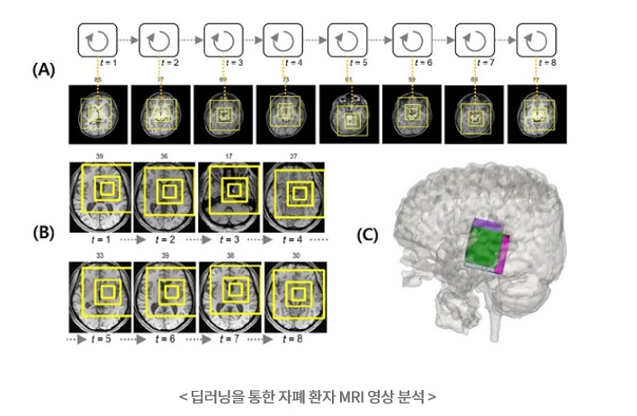 딥러닝을 통한 자폐환자 MRI 영상 분석.jpg